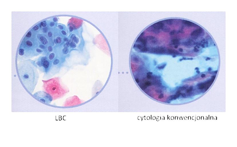 porownanie_cytologii-001-2014-04-23-_-17_58_38-75 Czy wiesz że rak szyjki macicy wykryty we wczesnym stadium jest niemal całkowicie uleczalny?